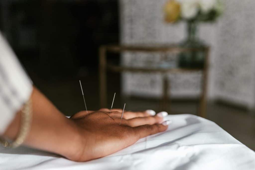 A person with acupuncture needles protruding from their hand, and manicured nails out of focus, rests their hand on a cloth-covered surface in a treatment room. View from midway down the forearm.